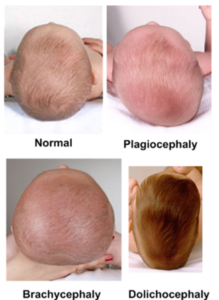 Plagiocephalie Tete Plate Osteopathes Lyon